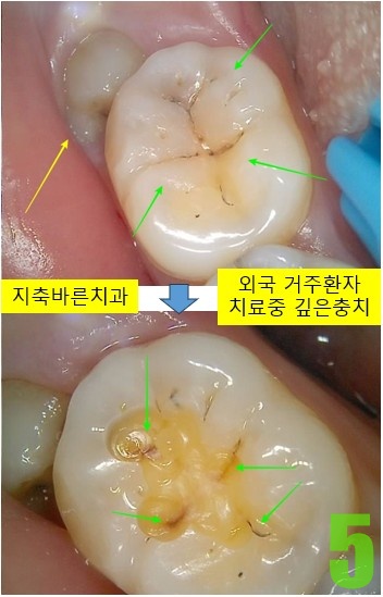 5. #47 치료중.jpg