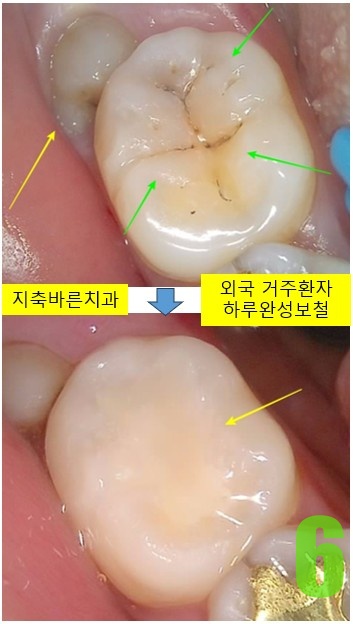 6. #47 치료전후.jpg