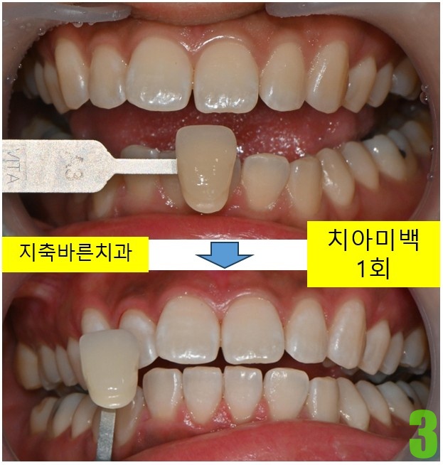 3. 미백 후.jpg