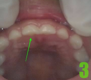 3. #51 발치.jpg
