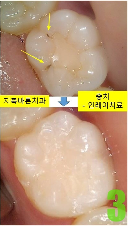 3. #36 인레이보철 치료전후.jpg