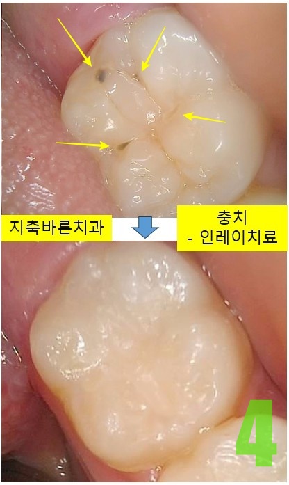 4. #37 인레이보철 치료전후.jpg