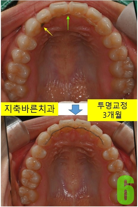 6. 치료전후 상악.jpg