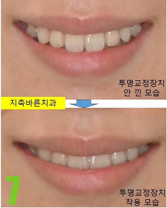 7. 투명교정 전후.jpg