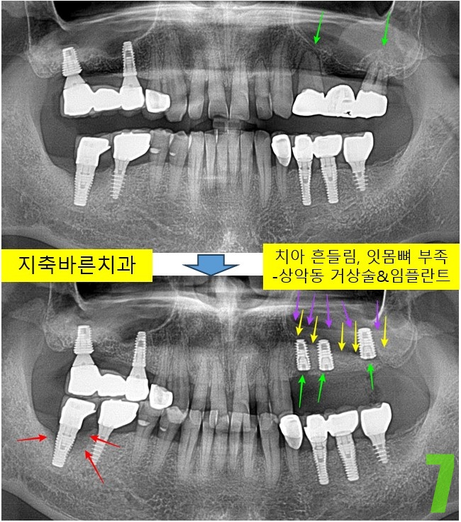 7. #24,25,27 임플 식립&상악동거상술.jpg