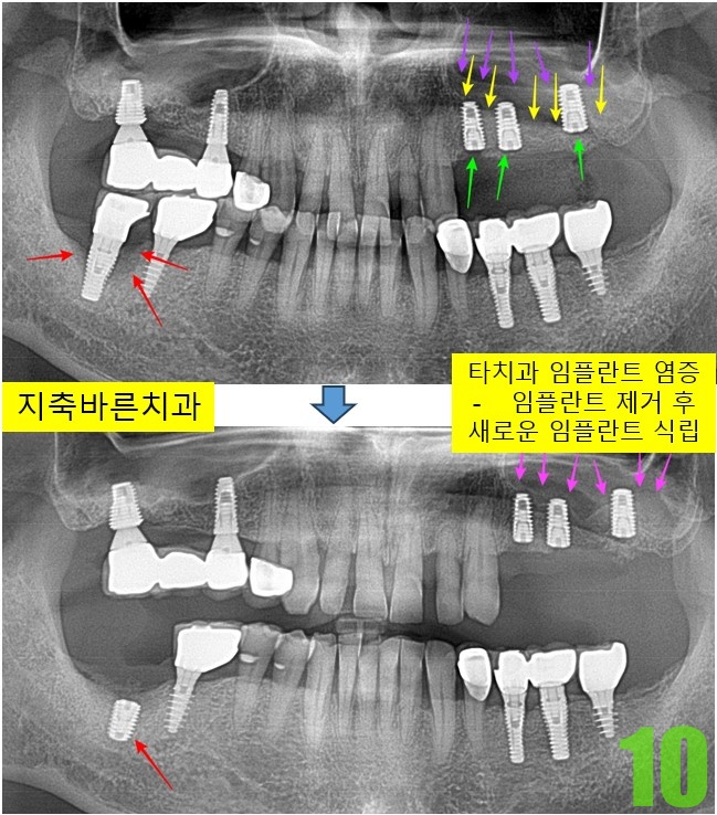 10. #47 임플 재식립.jpg