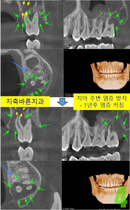 4. 1년후 #27 염증커짐.jpg