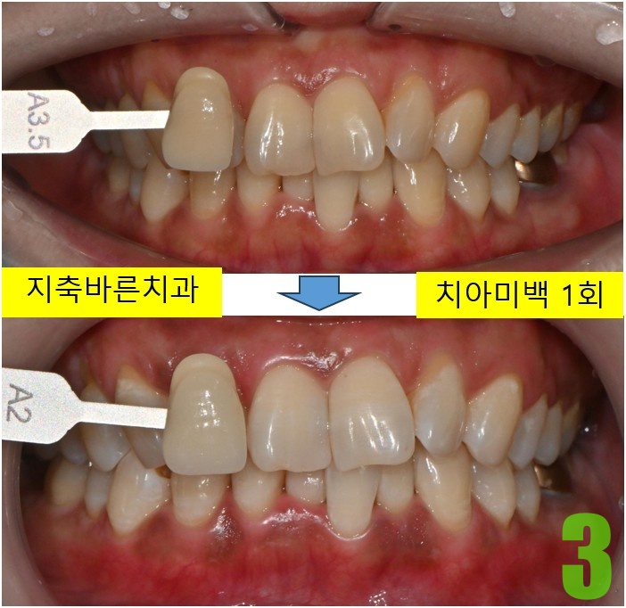 3. 미백 후.jpg