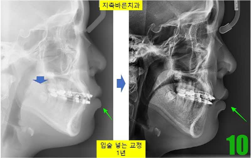 10. 치료 2년 셉_s.jpg