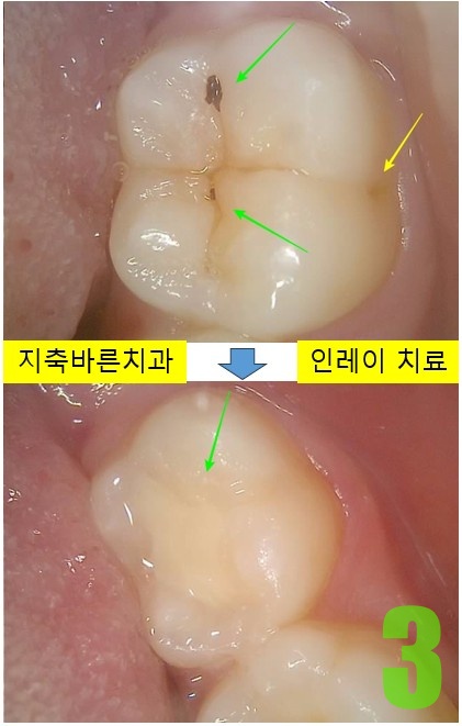 3. #37 인레이 치료.jpg