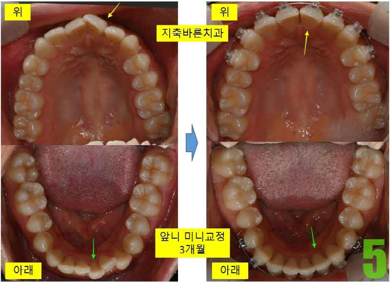 5. 교정 3개월 상하악_s.jpg