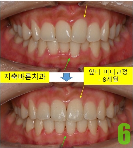 6. 교정 디본딩.jpg