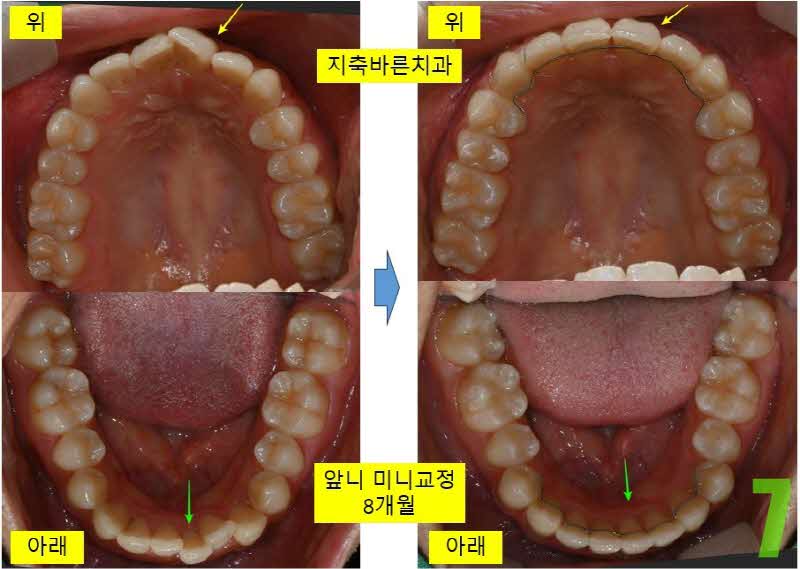 7. 교정 디본딩 상하악_s.jpg