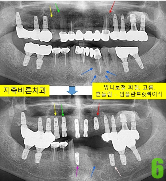 6. 4개월후 #23, 35,42 식립.jpg