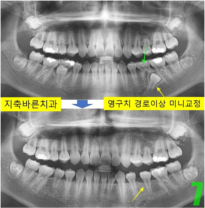 7. 불완전 디본딩.jpg