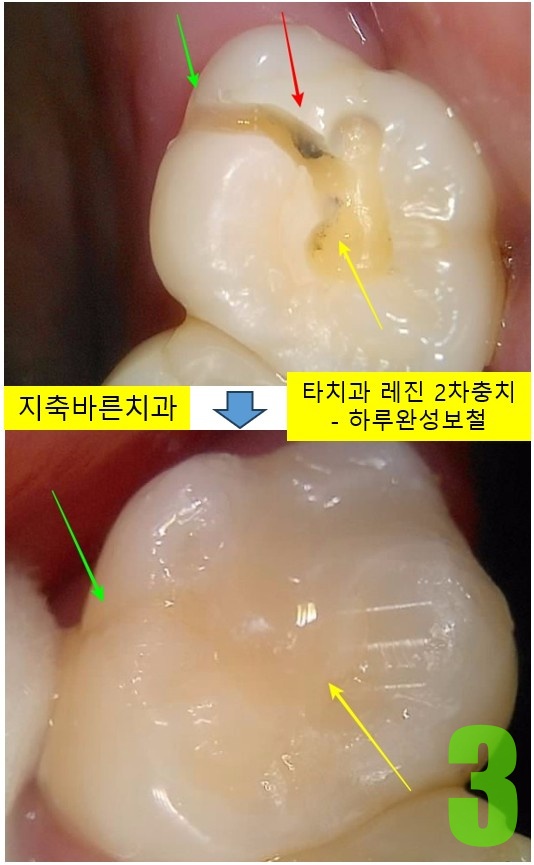 3. #17 충치치료.jpg