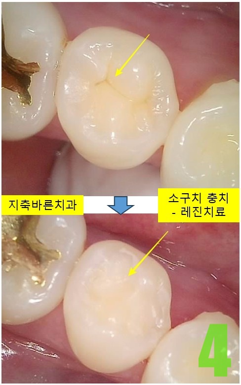 4. #45 레진치료.jpg