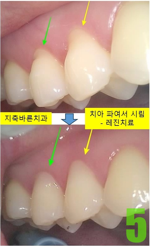 5. #10번대 치경부레진.jpg