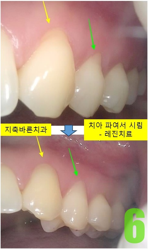 6. #20번대 치경부레진.jpg