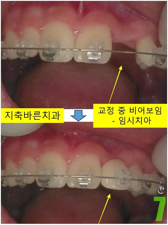 7. 앞니 임시치아.jpg