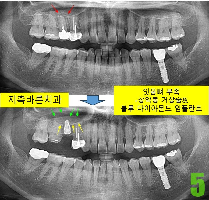 5. #15 임플 식립.jpg