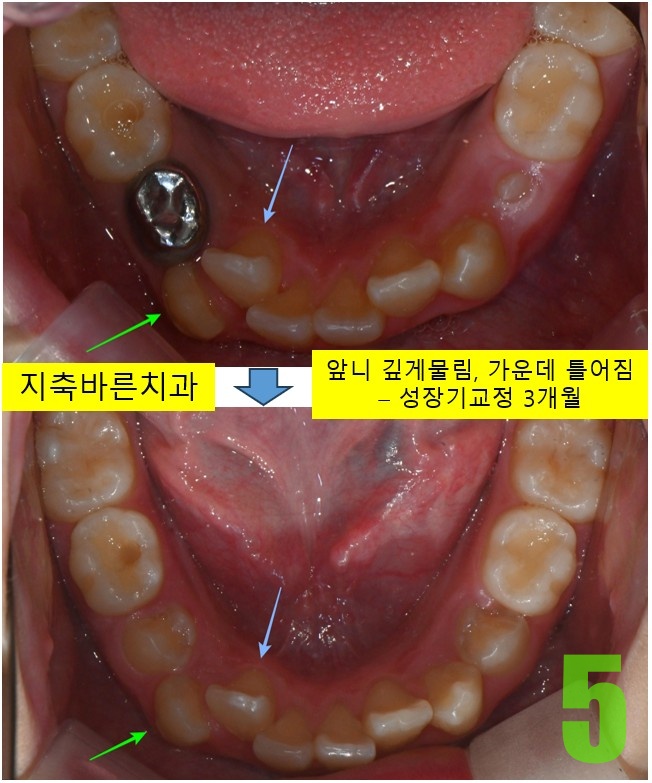 5. 3개월 하악.jpg